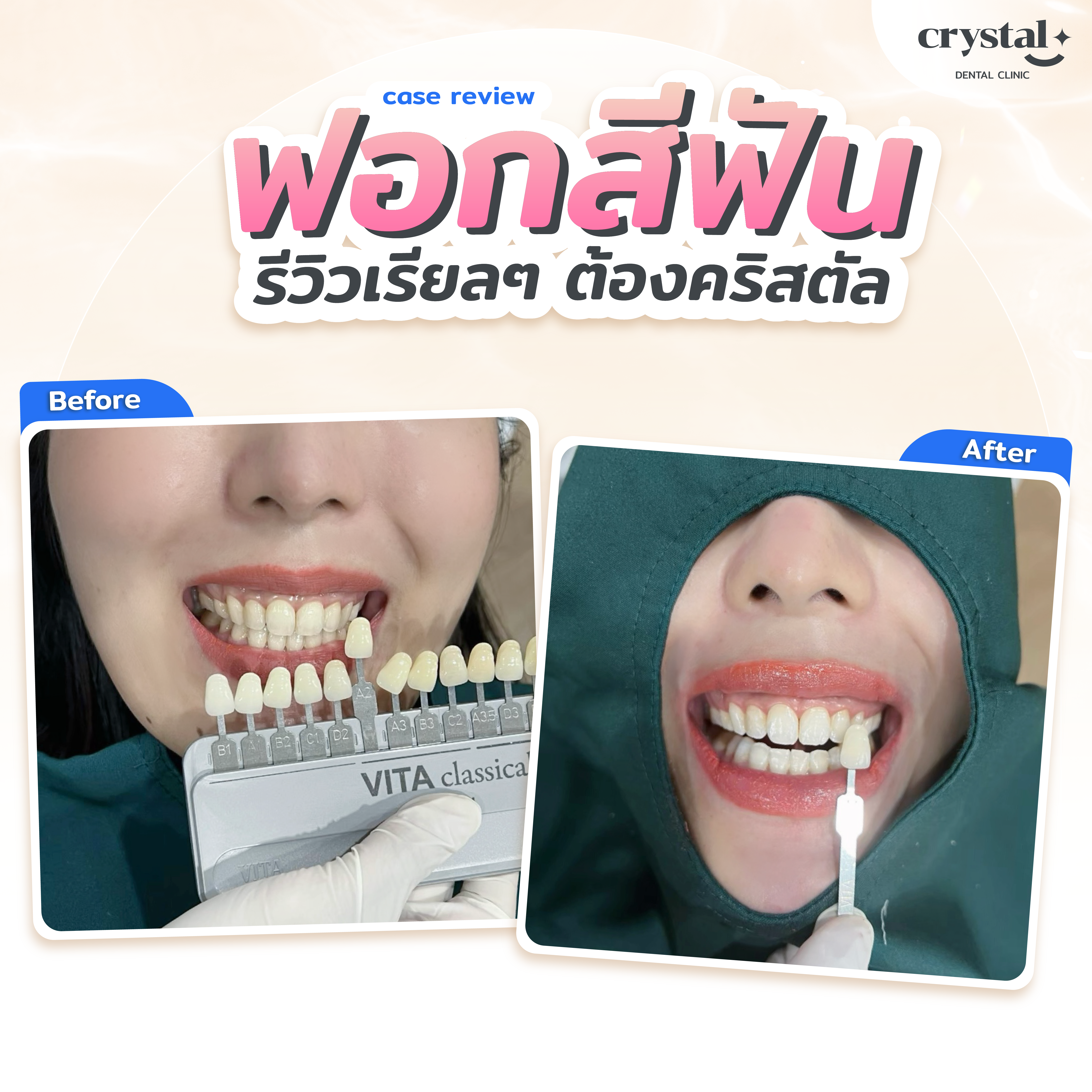 review whitening-01