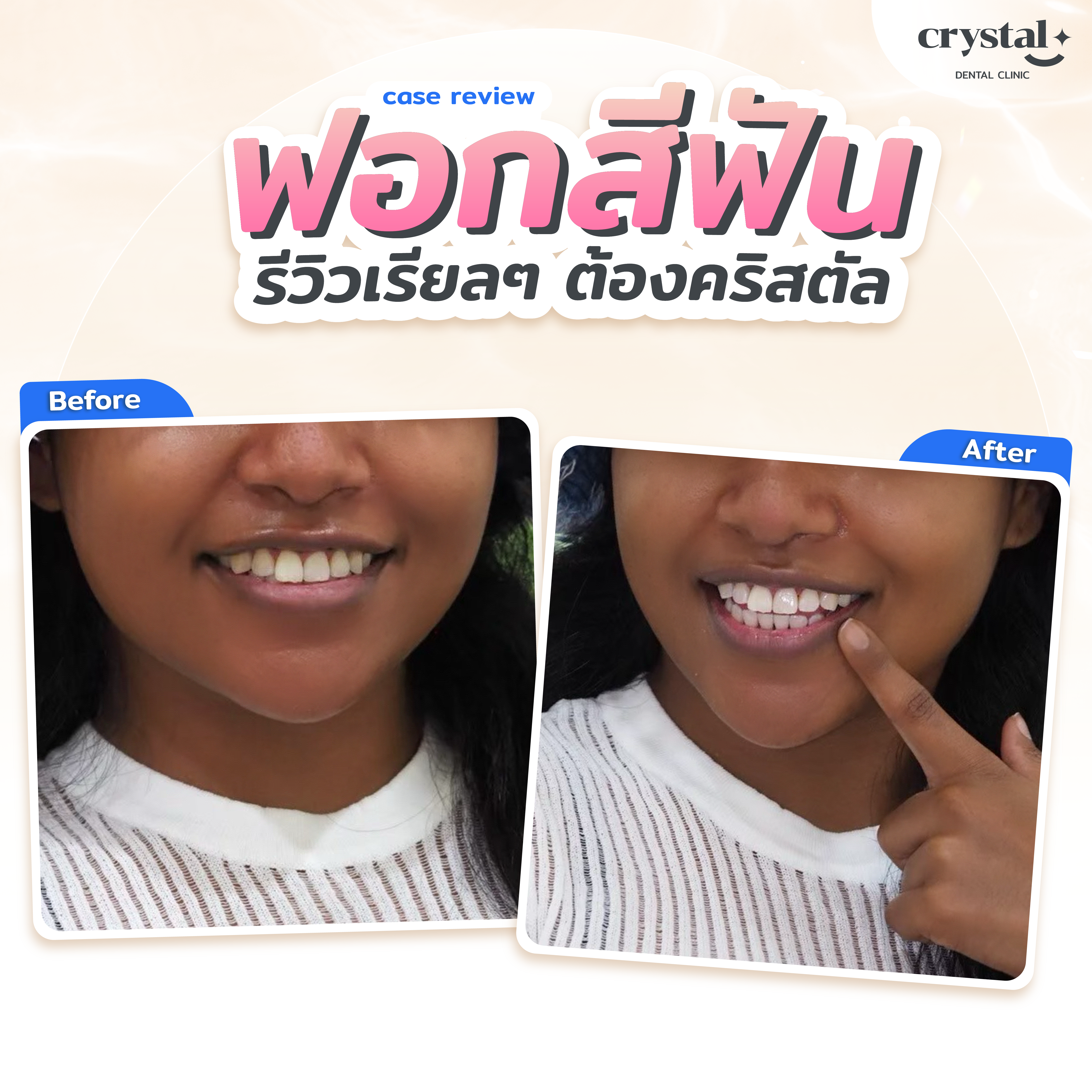 review whitening2-01