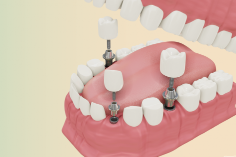 dental-implants-treatment-procedure-medically-accurate-3d-illustration-dentures-concept